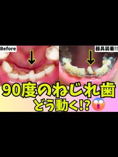 [x]36歳|1年4か月経過報告【歯列矯正経過