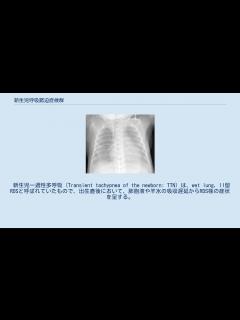 [x]新生児呼吸窮迫症候群 - YouTube